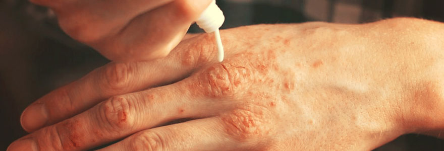 psoriasis en goutte